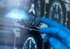 Testet dhe trajtimet për Alzheimerin janë të disponueshme tani, por ka pengesa që i pengojnë ato të arrijnë tek të gjithë. Alzheimers Insider