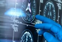Testet dhe trajtimet për Alzheimerin janë të disponueshme tani, por ka pengesa që i pengojnë ato të arrijnë tek të gjithë. Alzheimers Insider
