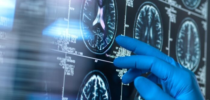 Alzheimers Insider
